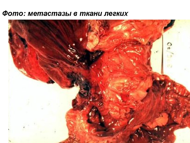 Фото: метастазы в ткани легких